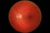 Picture of my Left Retina.jpg