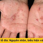 benhlytodia
