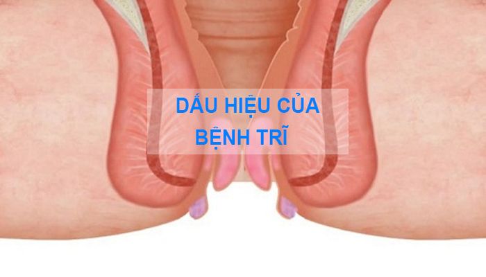 dau-hieu-cua-benh-tri-logo.jpg