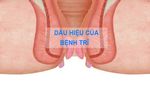 dau-hieu-cua-benh-tri-logo.jpg